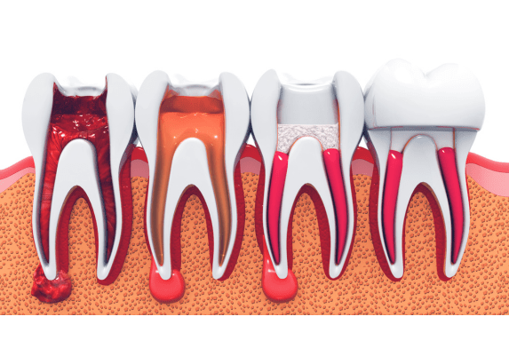Illustration of the stages of root canal treatment: infected pulp removal, cleaning and shaping, filling with gutta-percha, and placing a crown on the tooth.