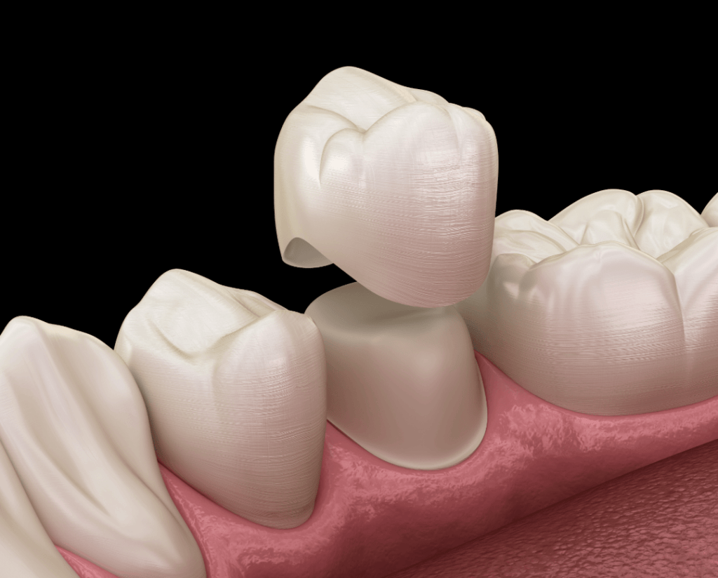 Dental crown front tooth