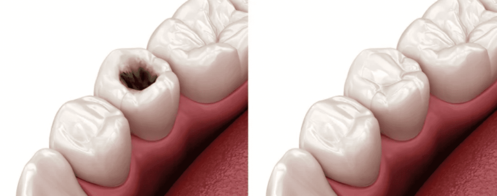 Teeth filling
Tooth filling