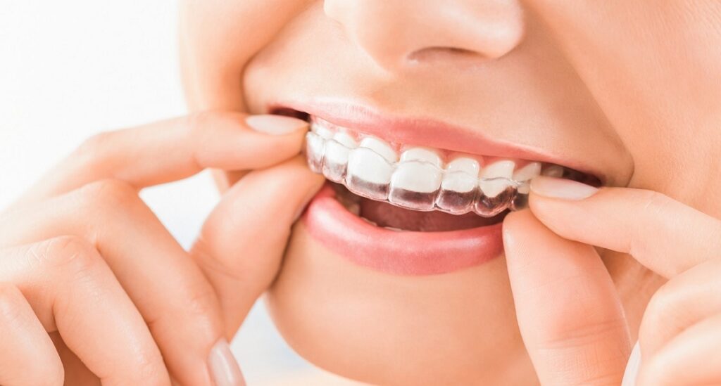 Invisalign teeth whitening